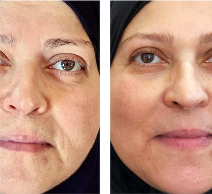 Microneedling Infusion kit: The Anti-Aging Solution