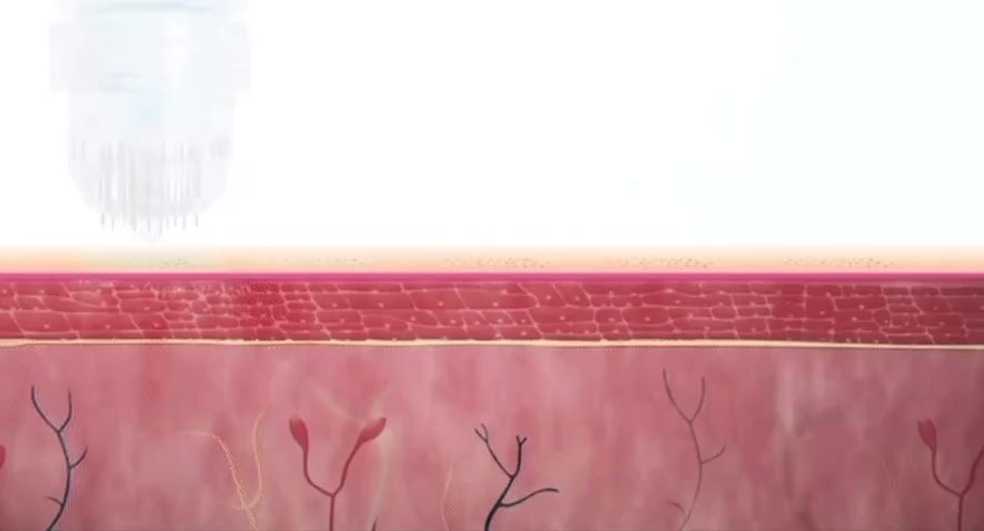 Load video: The Éclatdermis Micro-Infusion System penetrates where creams can't, using almost painless, 24K gold-plated microneedles to create tiny pathways in your skin. This gentle process stimulates a firmer, smoother feel while directly infusing powerful, customized serums to target fine lines and other concerns. It's the ultimate way to get more from your skincare.